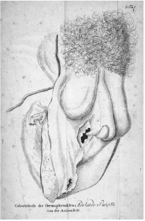Hermaphrodisie eines Menschen, 1797 par Friedrich Benjamin Osiander dans Neue Denkwürdigkeiten für Aerzte und Geburtshelfer, légendé "Geburstheile des Hermaphroditen Adelaïde Préville" I LO 2.0