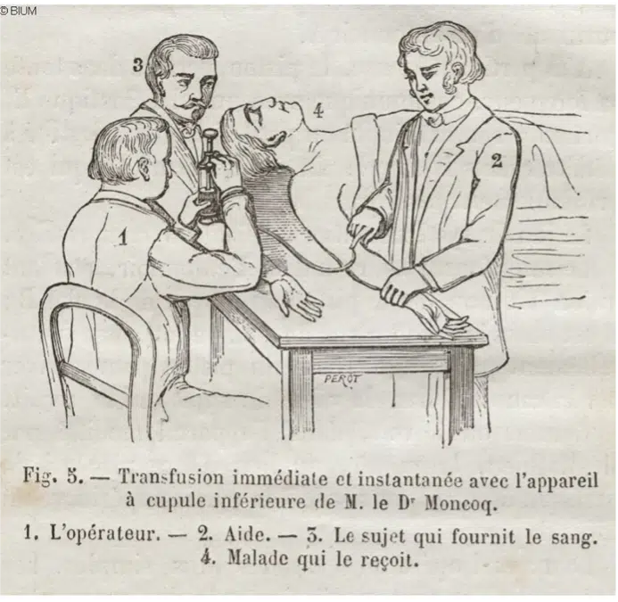 Représentation légendée d’une transfusion sanguine dans l’article « La Transfusion du sang » in La nature : revue des sciences et de leurs applications aux arts et à l’industrie, 1874, Charles Letort I Licence ouverte