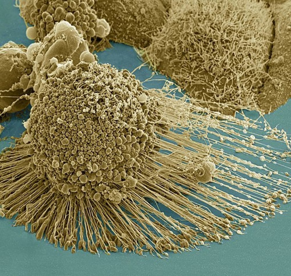 Micrographie électronique à balayage d'une apoptose des cellules HeLa | Domaine Public